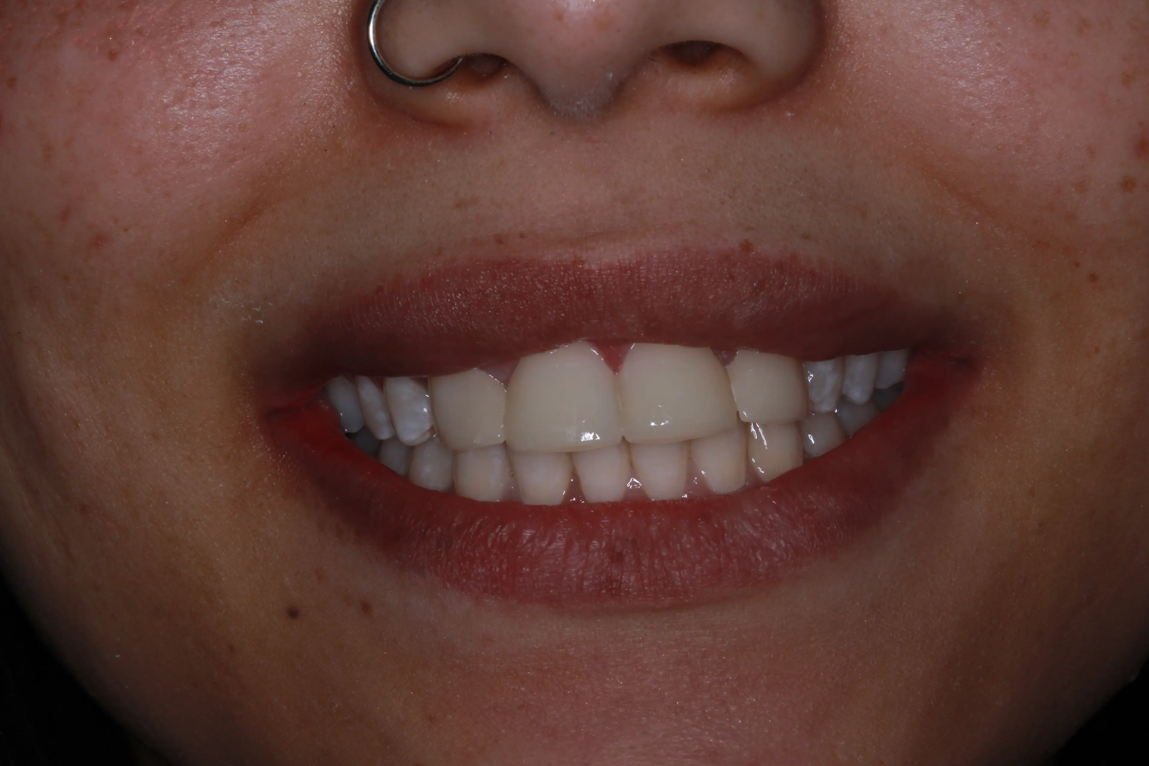 Successful composite bonding